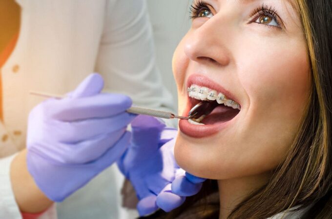 Types of Orthodontic Treatment