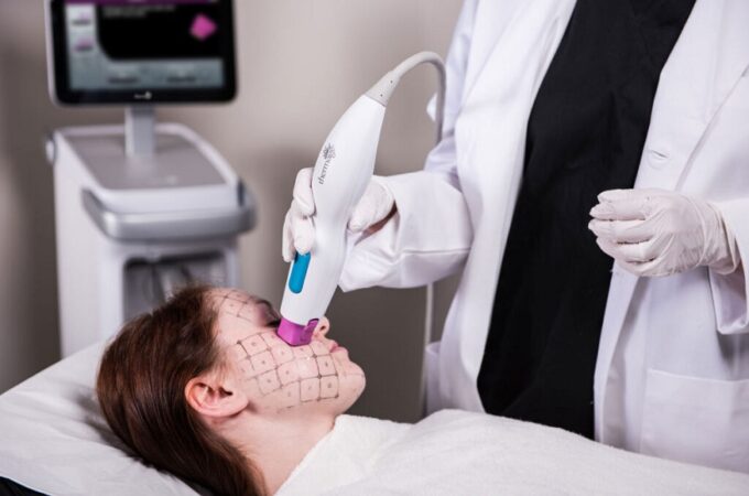 Thermage FLX: A Revolution in Tissue Tightening