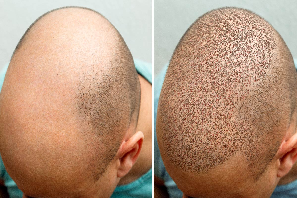 best hair transplant in Turkey