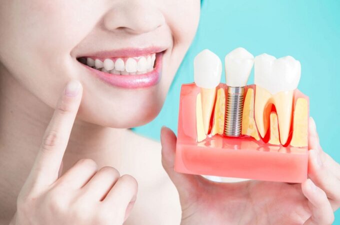 What are guided dental implants and what are their advantages?