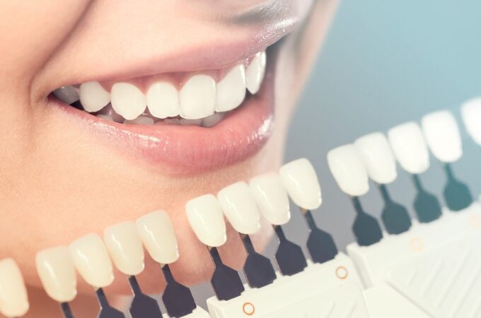 How Composite Bonding is Revolutionising Cosmetic Dentistry