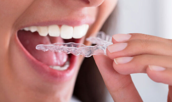 The Growing Trend of Invisalign Among Young Professionals