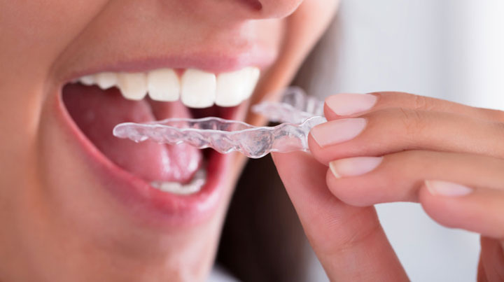 Invisalign London E