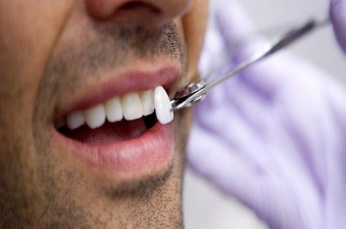 Enhancing Your Smile with Veneers: Options in Liverpool