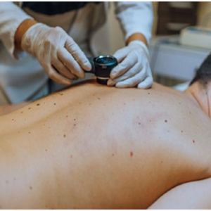 skin cancer