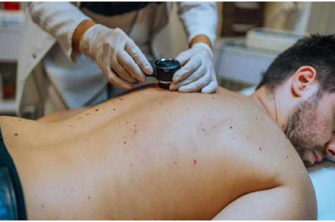 skin cancer