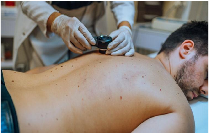 skin cancer