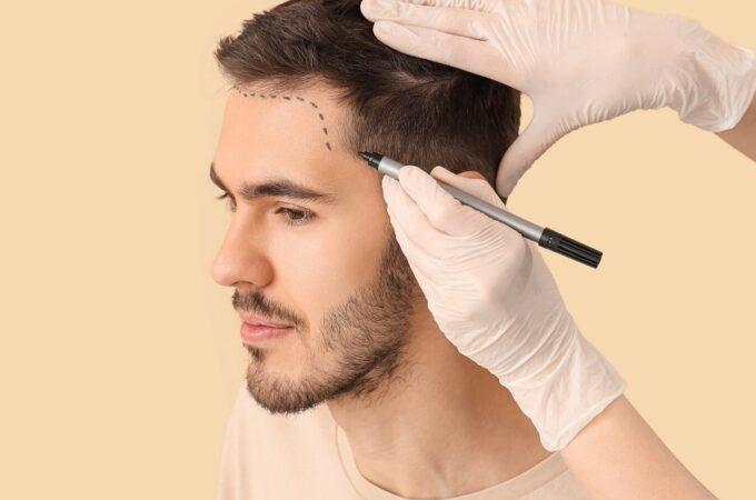 How Grace Touch Clinic Is Redefining Confidence Through Advanced Hair Restoration