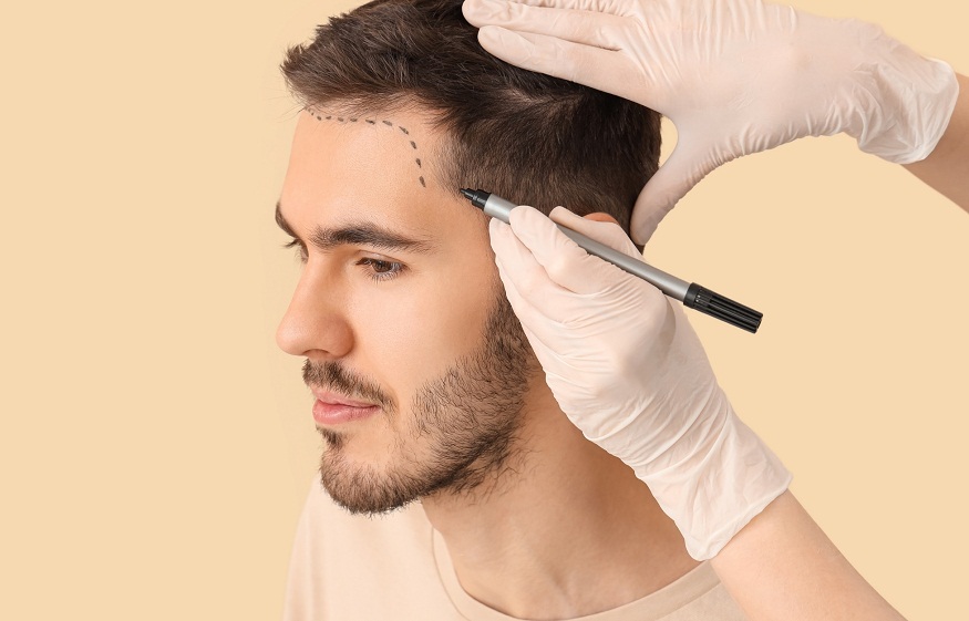 best hair transplant in Turkey
