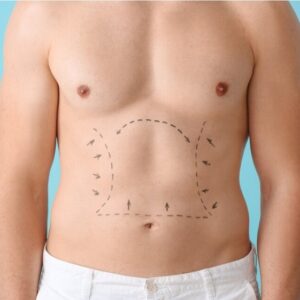 liposuction experts