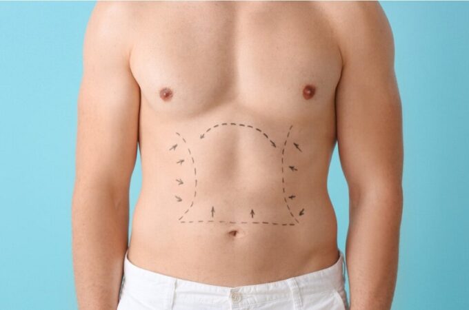 Rethinking Liposuction: What You Really Need to Know