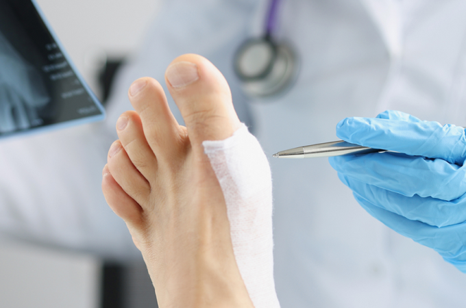 Placental Allografts