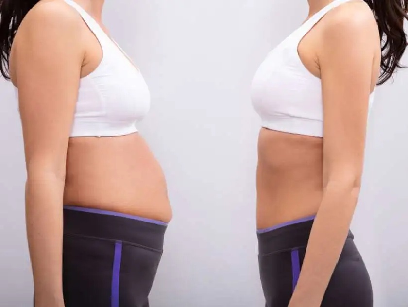 tummy tuck surgery in Hyderabad